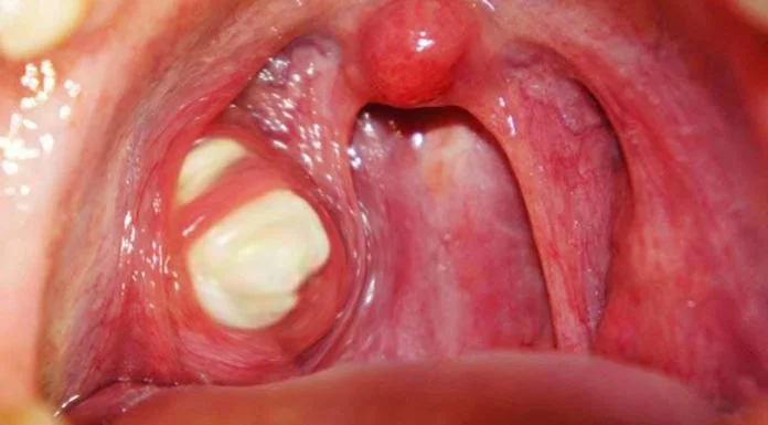 Can Tonsils Grow Back After Being Removed? – tymoff